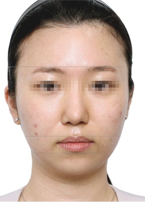 After treatment