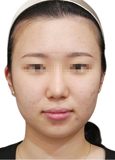Before treatment