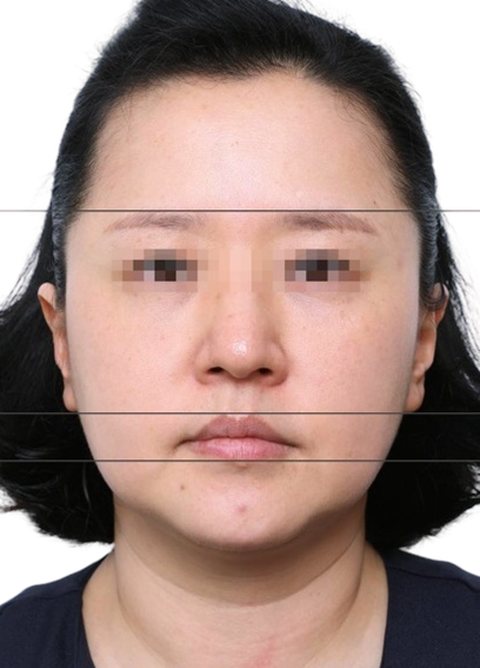 Before treatment